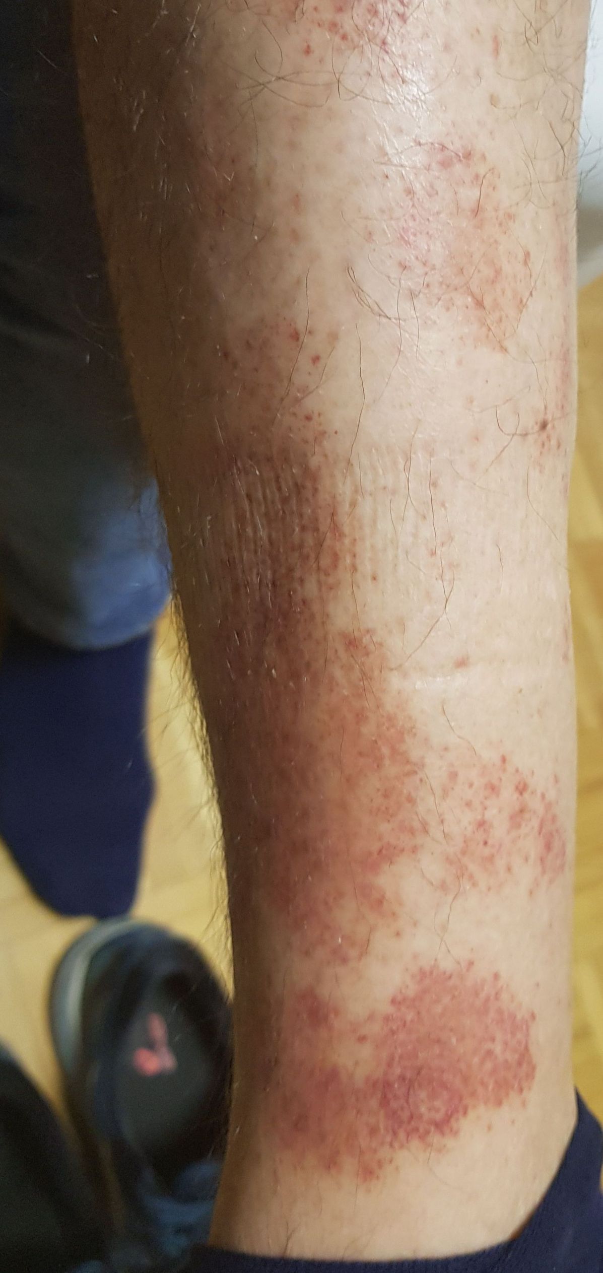 Prej: golen od sredine do gležnja, posejana z drobnimi temno rdečimi pikami, ki se ob gležnju zlivajo v lise.