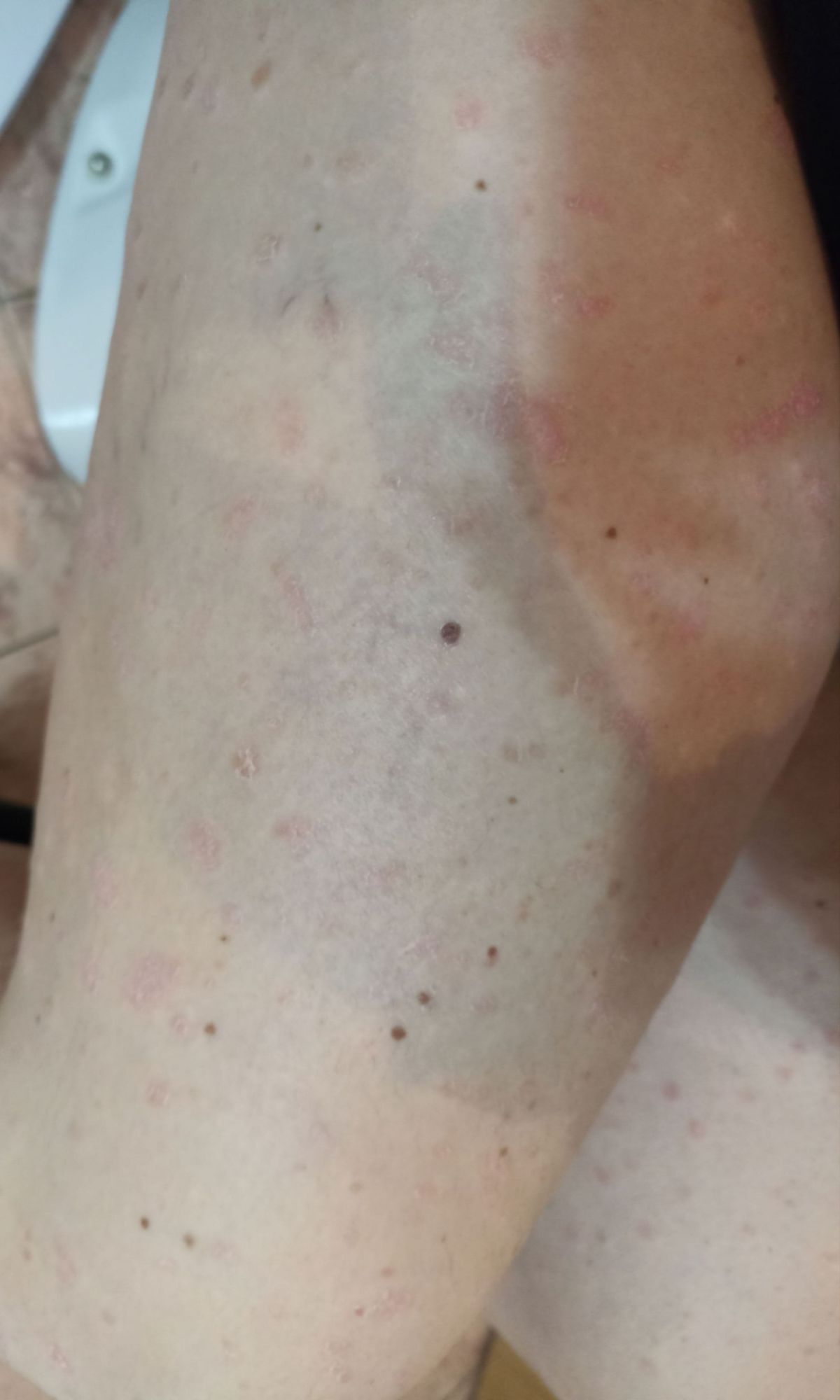 Potem: stegno, posneto od zgoraj; koža je svetla, z redkimi bledo rožnatimi pikami, na desni zagorela.